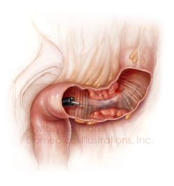 Colonic-obstruction-copyright