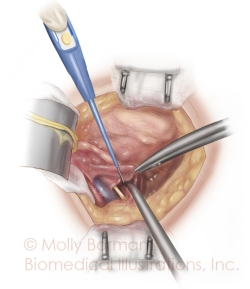 Cystectomy-copyright