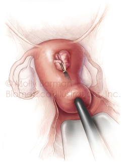 Fibroid-Removal-copyright