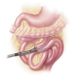 GastricBypass