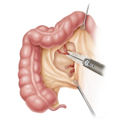 colectomy400